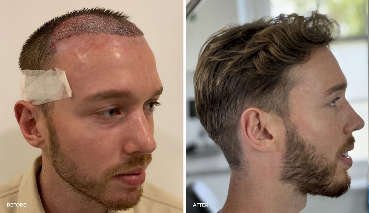 Advanced Hair Transplant UK Solutions for Lasting Results