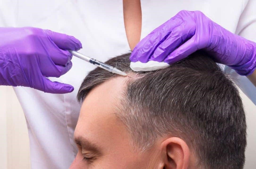 Hair Transplant – Leading Specialists in the UK