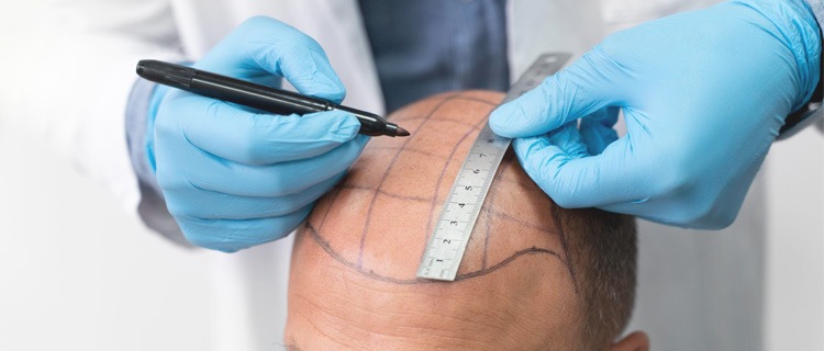 Hair Transplant Istanbul: The Capital of Hair Restoration