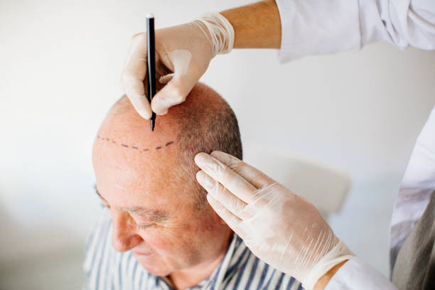 Hair Transplant Turkey Cost Explained by Experts